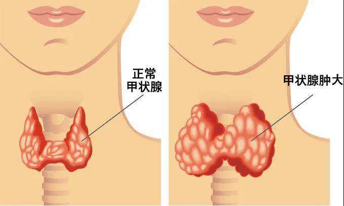 甲狀腺腫.jpeg